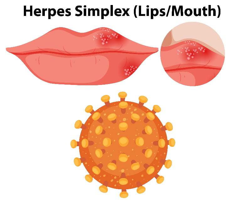 Cibi da non mangiare con l’herpes