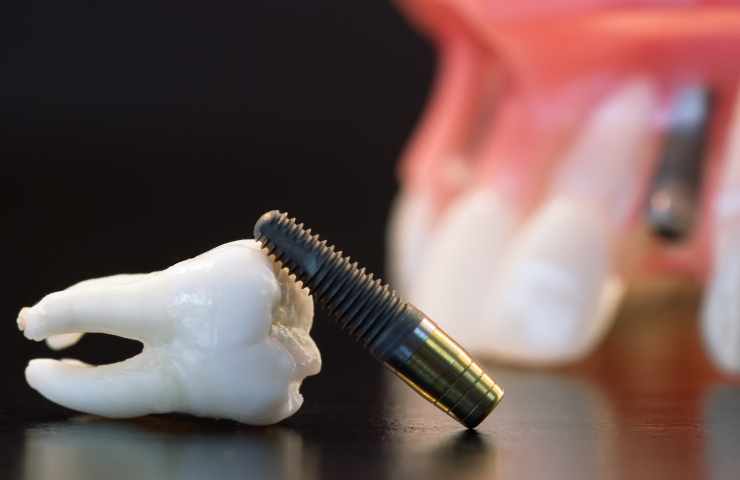 estrazione denti